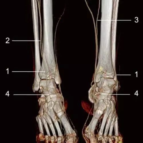 新入行必看!下肢动静脉cta解剖和10种常见疾病【影像学院039】