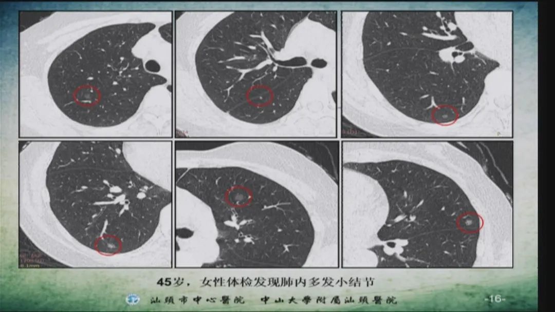 推荐哪些人要进行低剂量螺旋ct的检查?