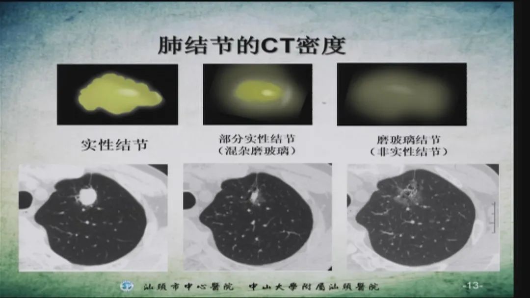 健康新生活肺部筛查有利器
