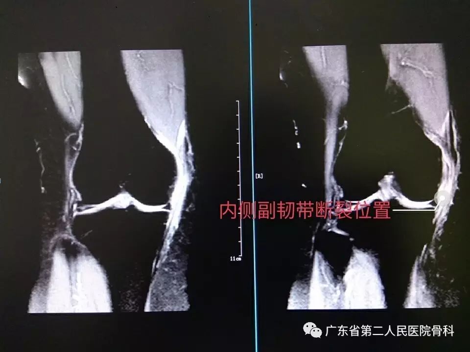 膝关节内侧副韧带损伤与修复案例分享