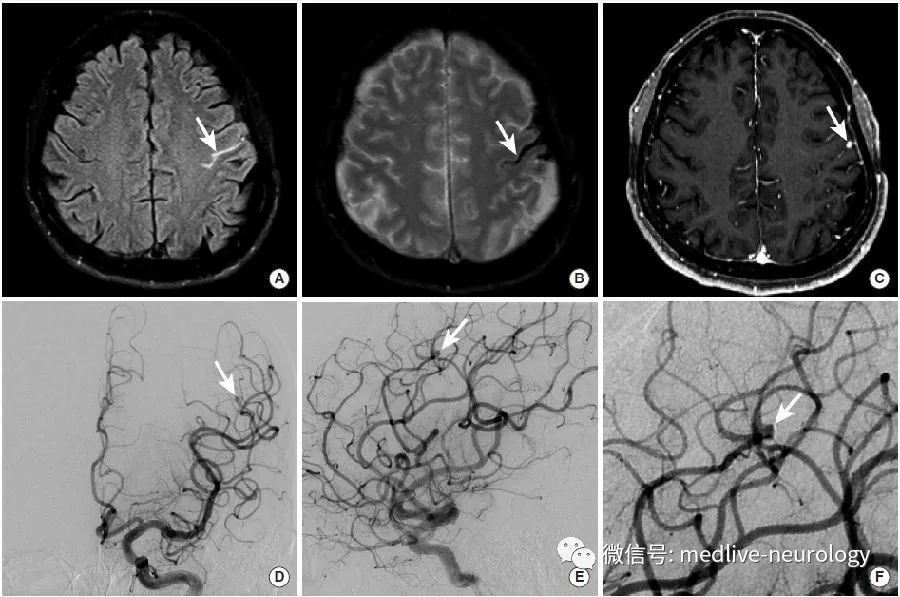 图17 一例感染性动脉瘤破裂致脑沟蛛网膜下腔出血患者的影像.