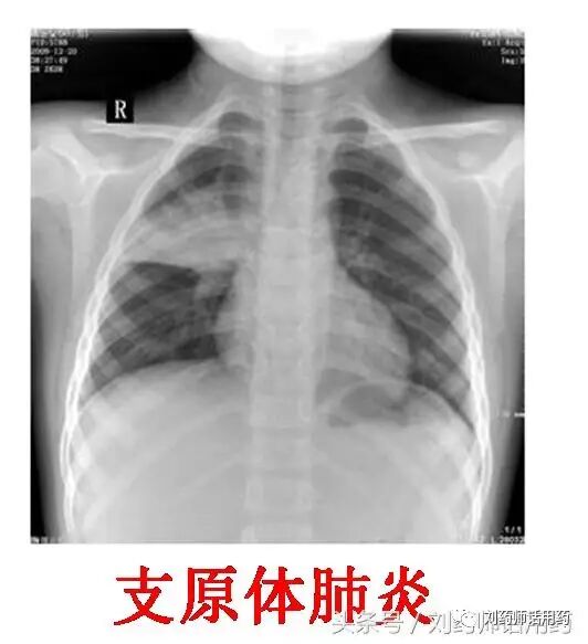 阿奇霉素治疗儿童支原体肺炎为什么有的用3天，停4天；有的用5天，停4天？