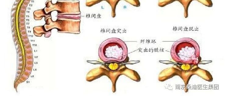 腰部 脊柱 管 狭窄 症 看護