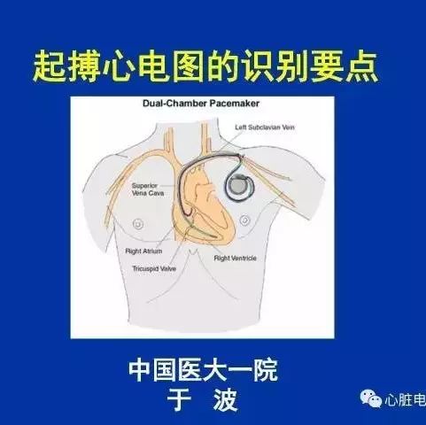 于波:起搏心电图的识别要点