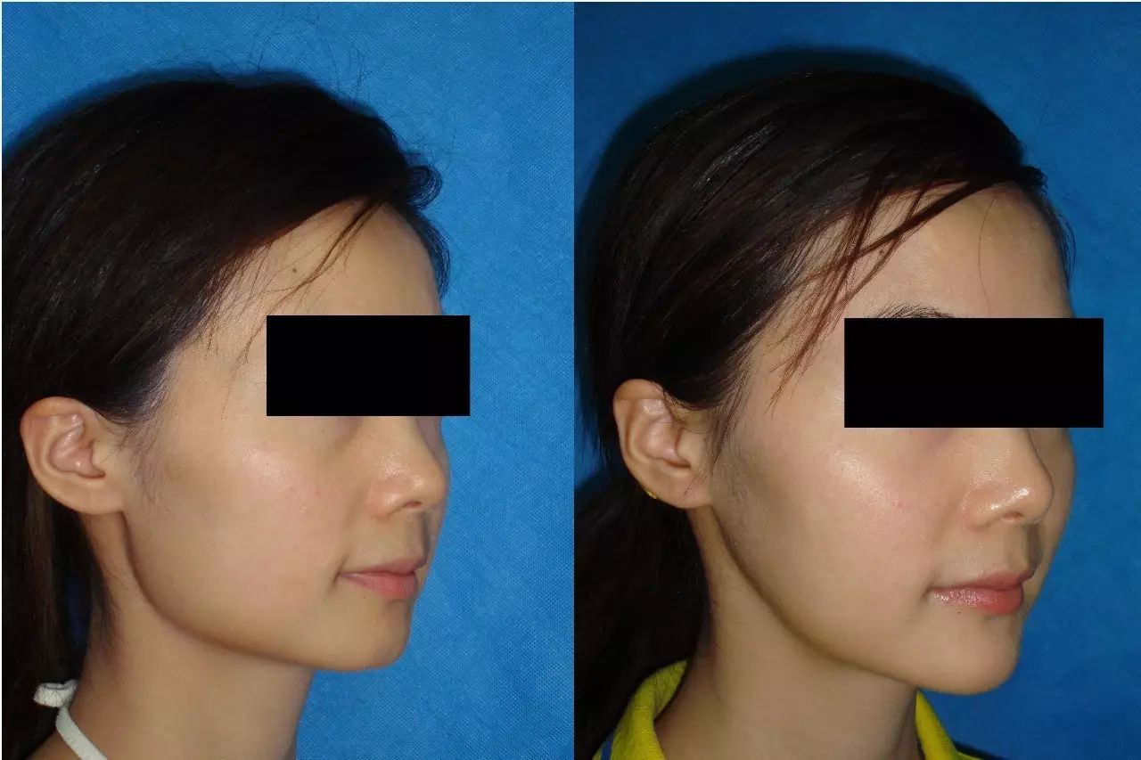 主要原因是咬肌肥大(masseter muscle hypertrophy)多伴有下颌角向