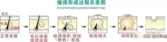 痘印的烦恼_痘印心得经验_痘印的解决方法