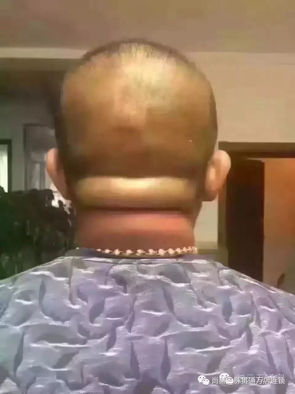 玻妃理疗教程tbs调理颈椎大包脑后堆肉的神奇效果真实案例