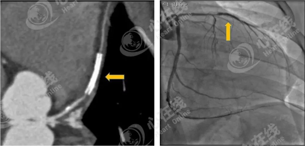 【微课堂】冠脉cta:冠状动脉支架的cta评价
