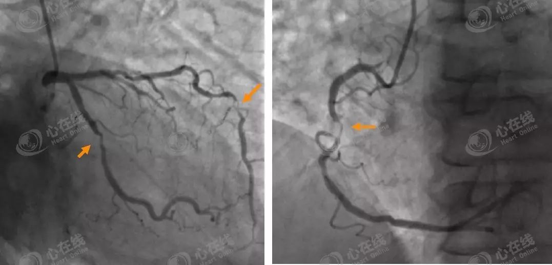 三支病变患者冠脉造影图像