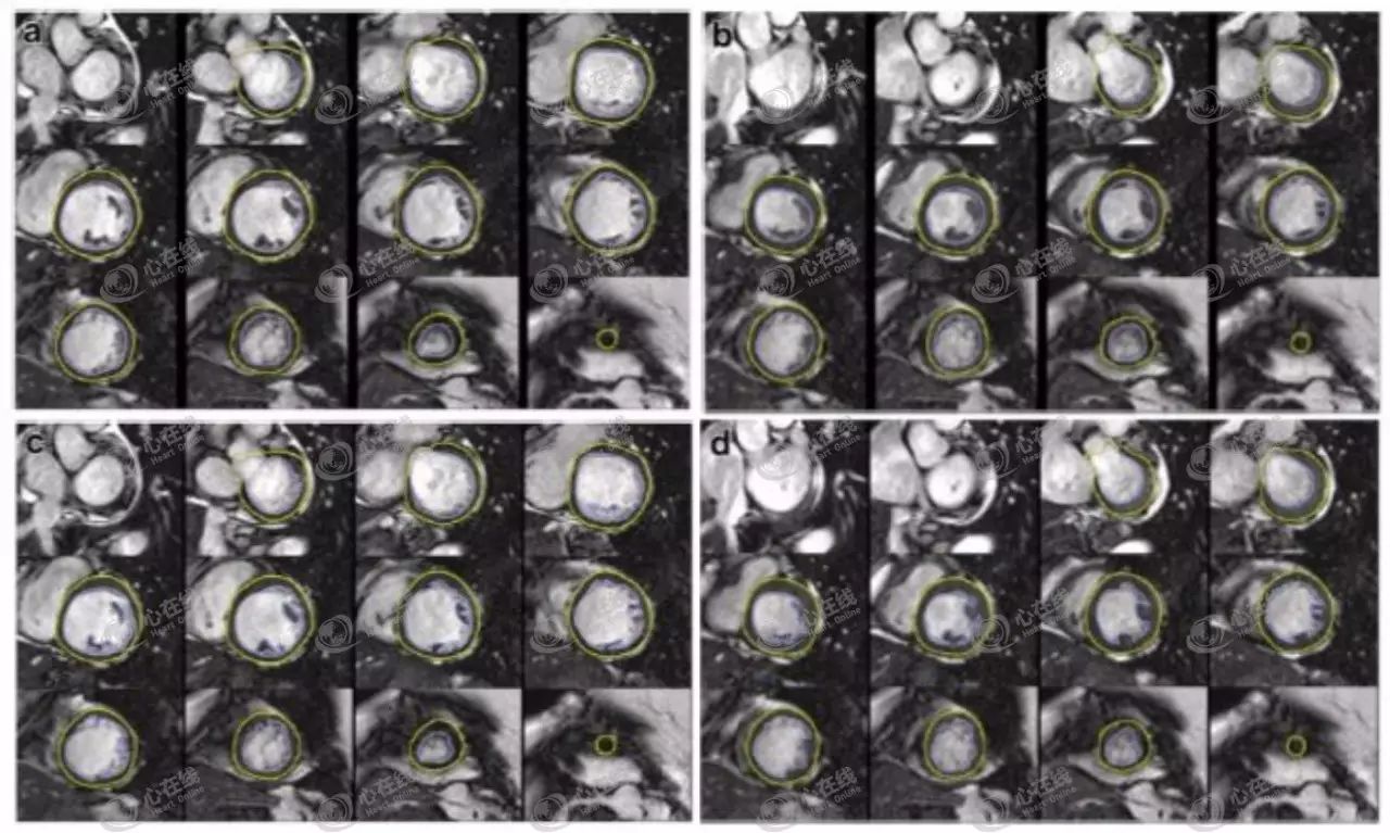 c,d均为由心尖至心底的心脏短轴电影图像,在工作站上逐层勾画出心内膜