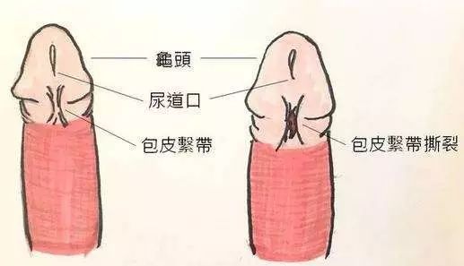 系带全称为包皮系带，是阴茎下面正中一条连接龟头与阴茎体的皮褶。