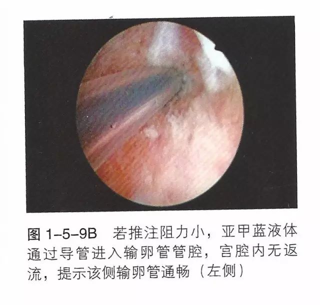 宫腔镜篇宫腔镜治疗术的操作方法