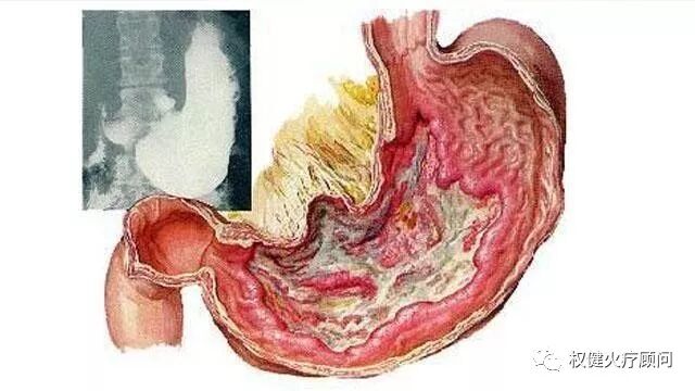 什么理疗仪器治胃病【胃病医生】浅表性胃炎，伴糜烂，胃溃疡？老中医“两味药”去根儿！_https://www.jmylbn.com_新闻资讯_第4张