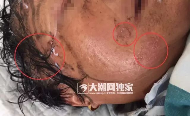长满一圈会死人？海宁有人得“怪病”头皮长满水泡~此病正值多发还会传染…