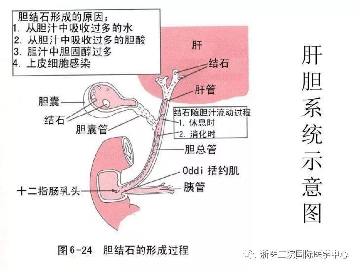 迷宫中的游刃有余漫谈肝内胆管结石微创取出术