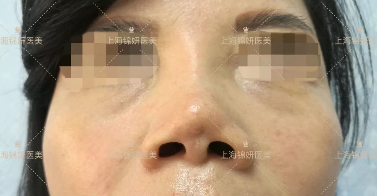 罕见"硅胶假体"隆鼻后鼻畸形病例报道