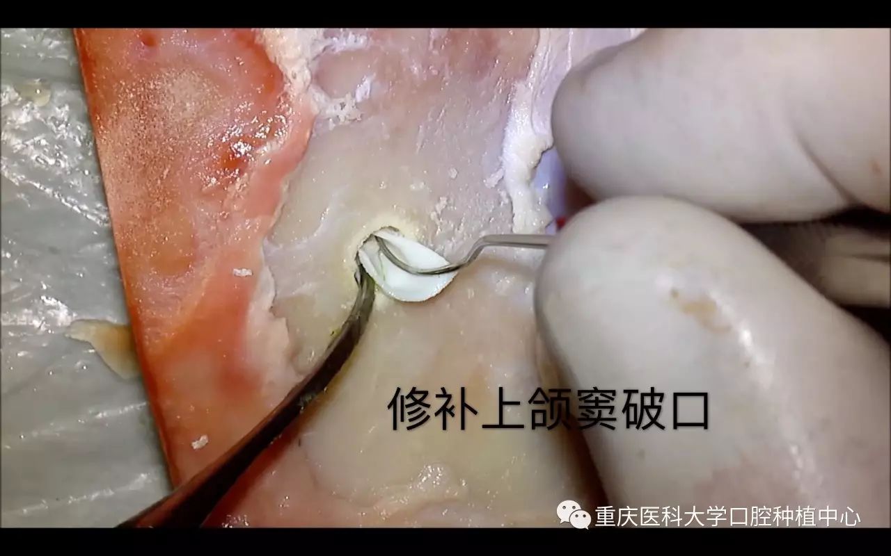 快和我们一起,0距离接触上颌窦!