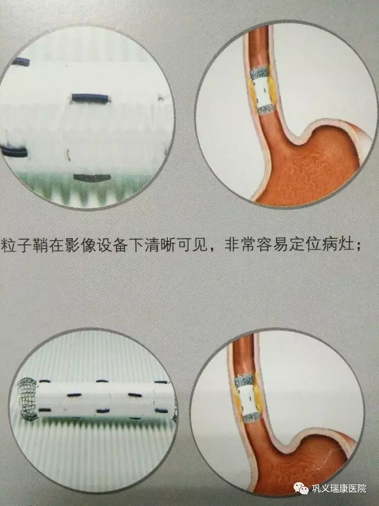 粒子支架,集杀灭肿瘤与解决狭窄为一体,标本兼治,为无法手术的食道癌