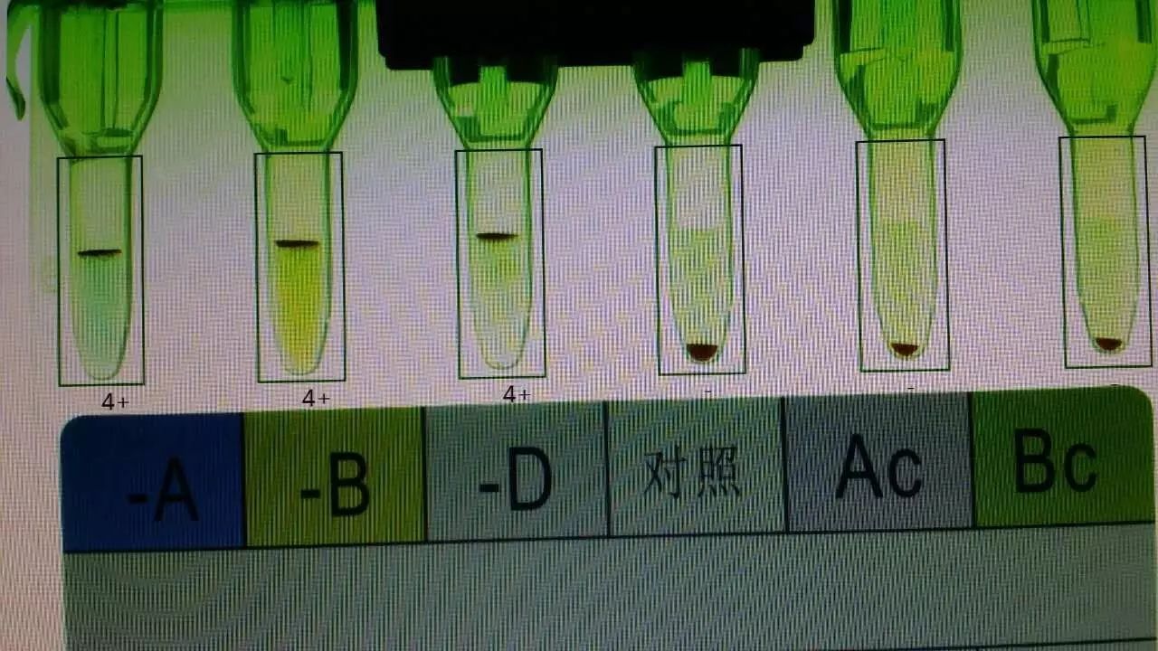 【焦点】备孕抽血检查,竟是罕见"恐龙血"济医附院发现1例"类孟买血型"