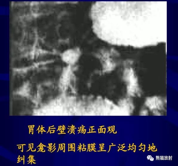 慢性胃炎,胃溃疡的x线诊断要点