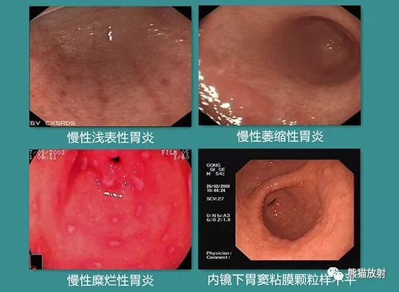 慢性胃炎,胃溃疡的x线诊断要点