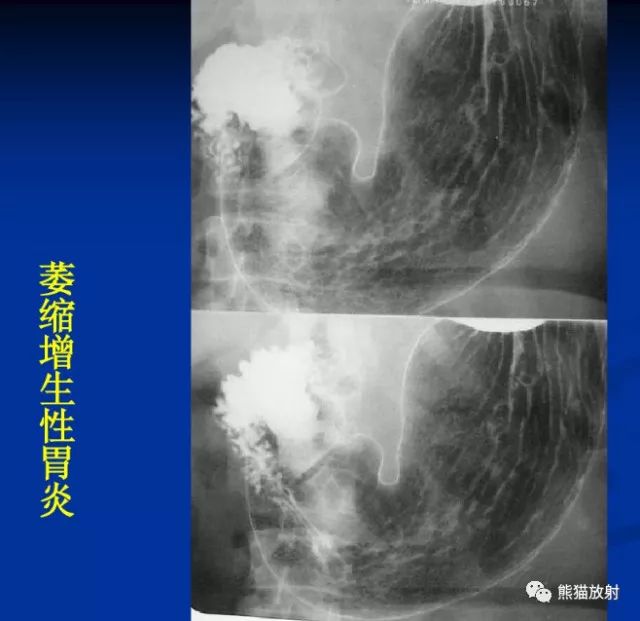 慢性胃炎,胃溃疡的x线诊断要点