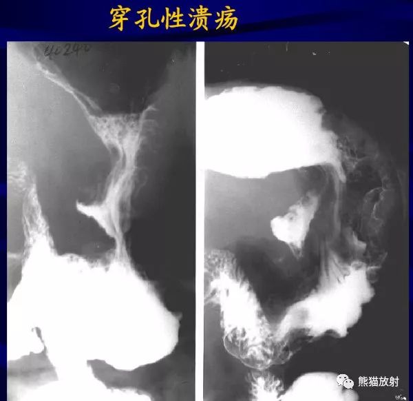 慢性胃炎,胃溃疡的x线诊断要点