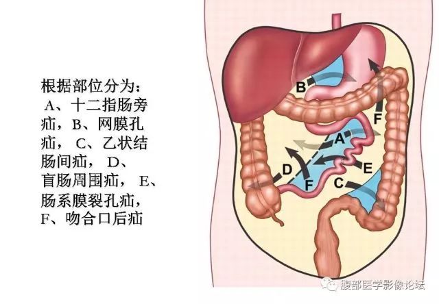 一例坏死性憩室炎病例回顾