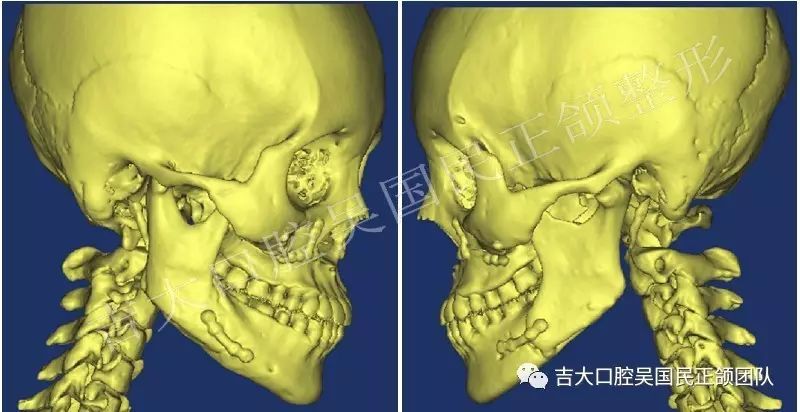 "数字化 个性化 精准化"时代—吉大口腔正颌的思考与实践