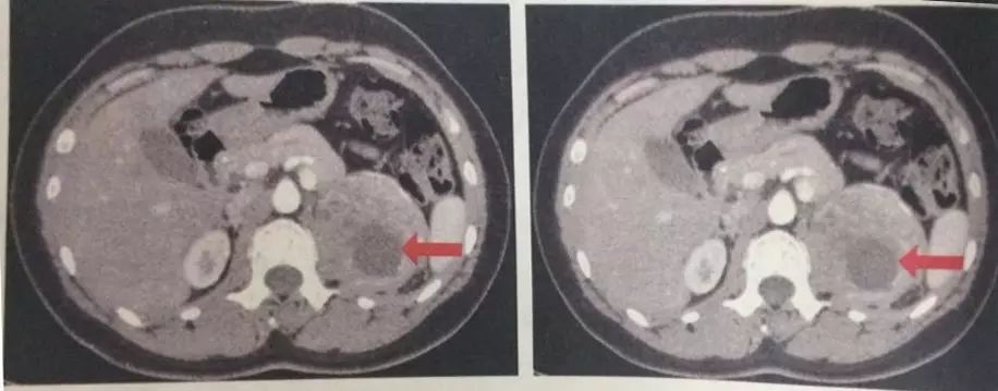 图1. 肾上腺ct平扫及增强扫描