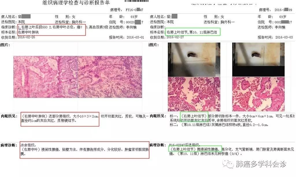 (2016-3-3):(右肺上叶结节)微浸润性高分化腺癌;(右肺中叶)浸润性腺癌