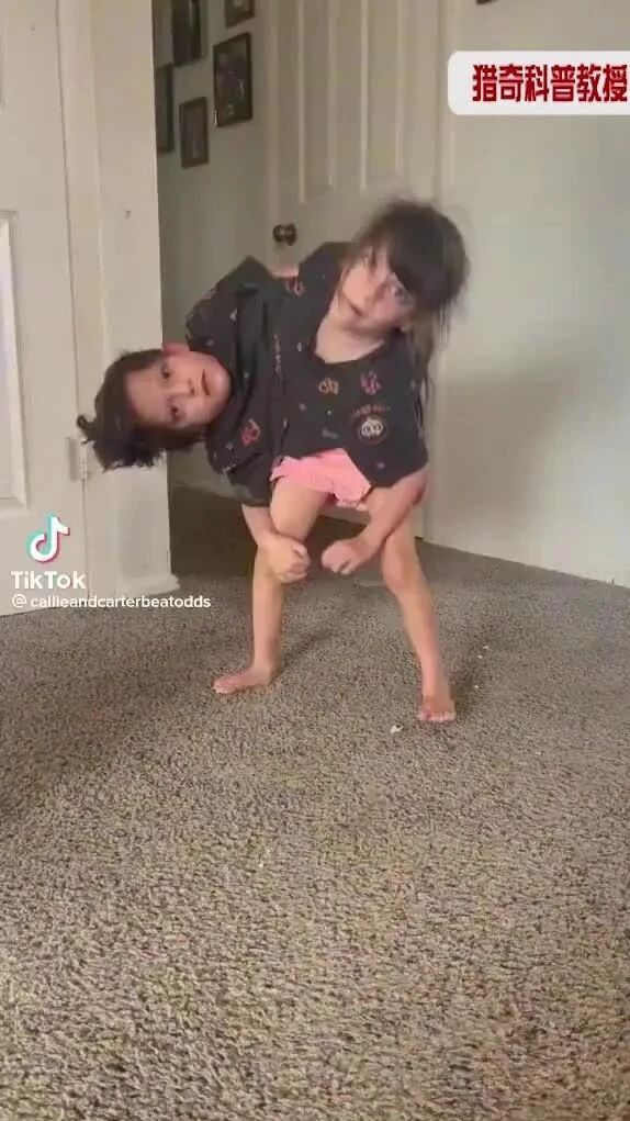 实拍 ▪ 共用下半身的连体孩-1