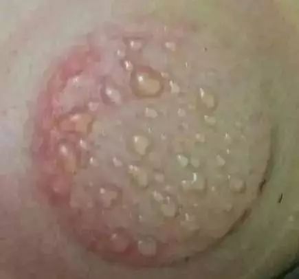 拔罐后的罐印都暗示了啥?看看吧!