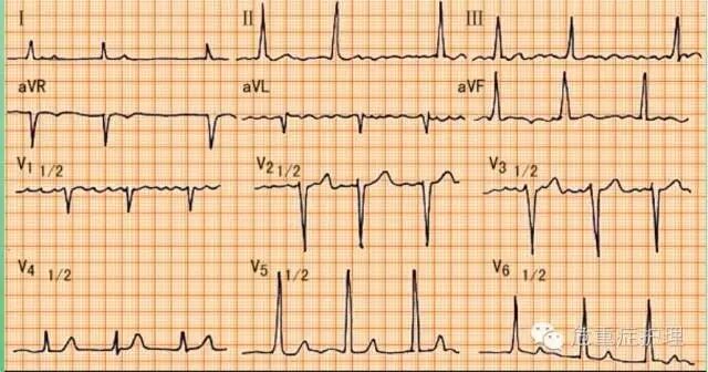 为什么选择双相波心脏电复律你不知道的事_https://www.jmylbn.com_新闻资讯_第8张