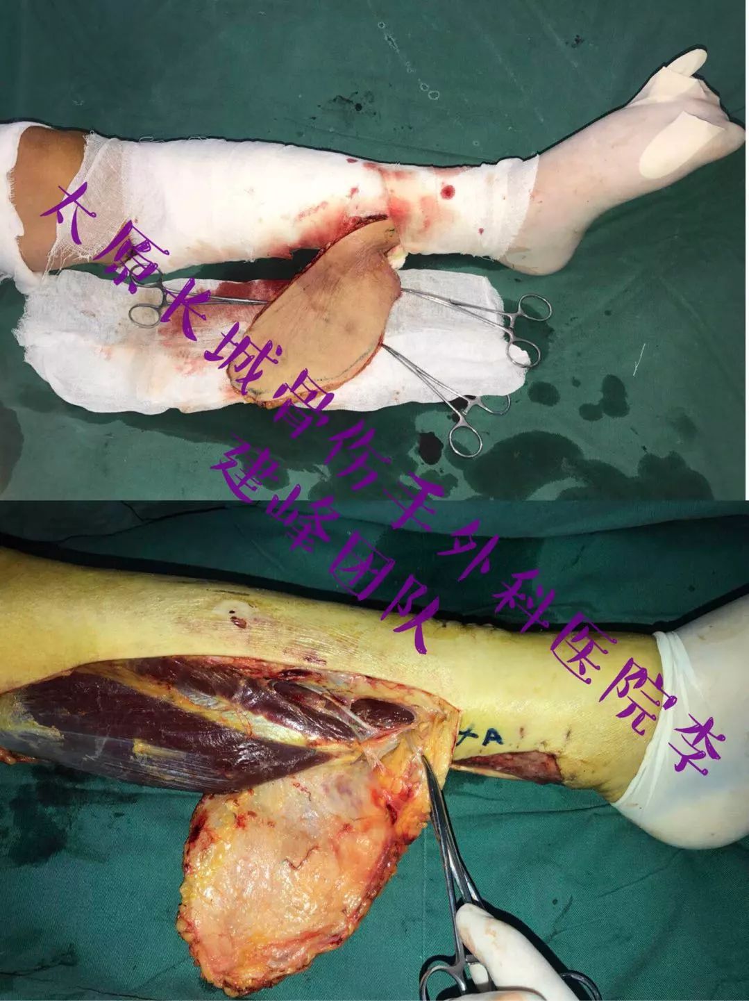 胫后动脉穿支皮瓣修复小腿远端外侧软组织缺损病例分享