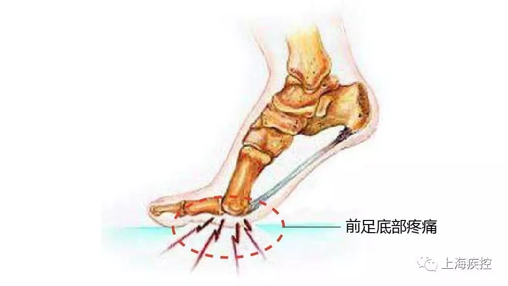 跖痛症:指前足劳损或跖神经受压或刺激,引起前足底部疼痛的病症.
