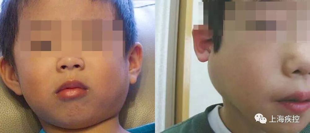 你孩子大嘴巴?这是流行性腮腺炎!