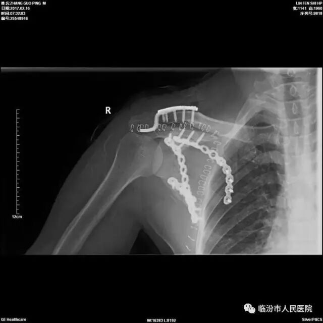 临汾人民医院骨创伤一科诊治一例复杂肩胛骨骨折合并肩锁关节脱位患者 临汾新闻网