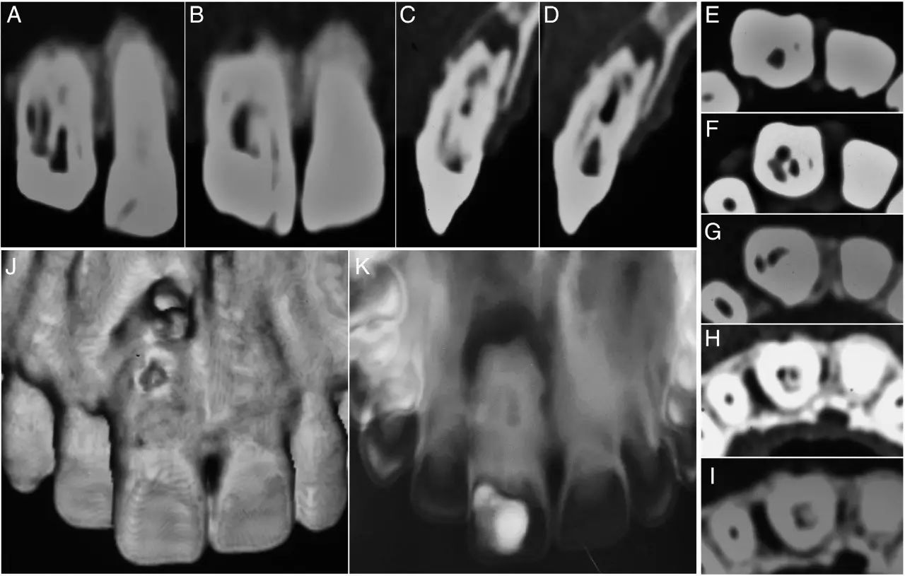 b:唇部可以看到另外两个根管(m和dm;c和d:矢状面可以看到环形的牙内