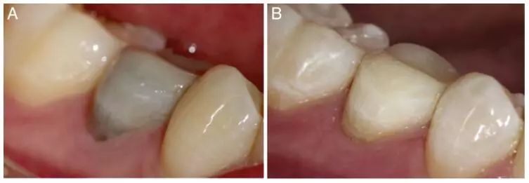 牙髓再生成功后变色牙的漂白及髓腔残留物的检测
