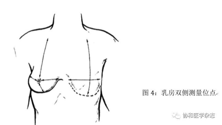 乳腺癌术后乳房再造术式的选择