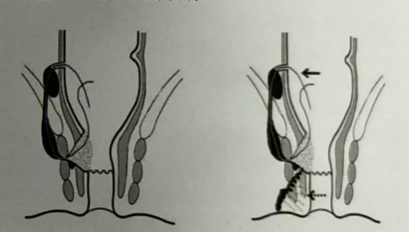 高位括约肌外肛瘘经瘘管顶端直肠内挂线