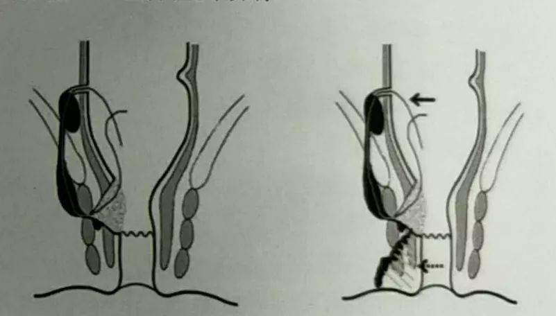 动力学原理指导下的高位复杂性肛瘘手术