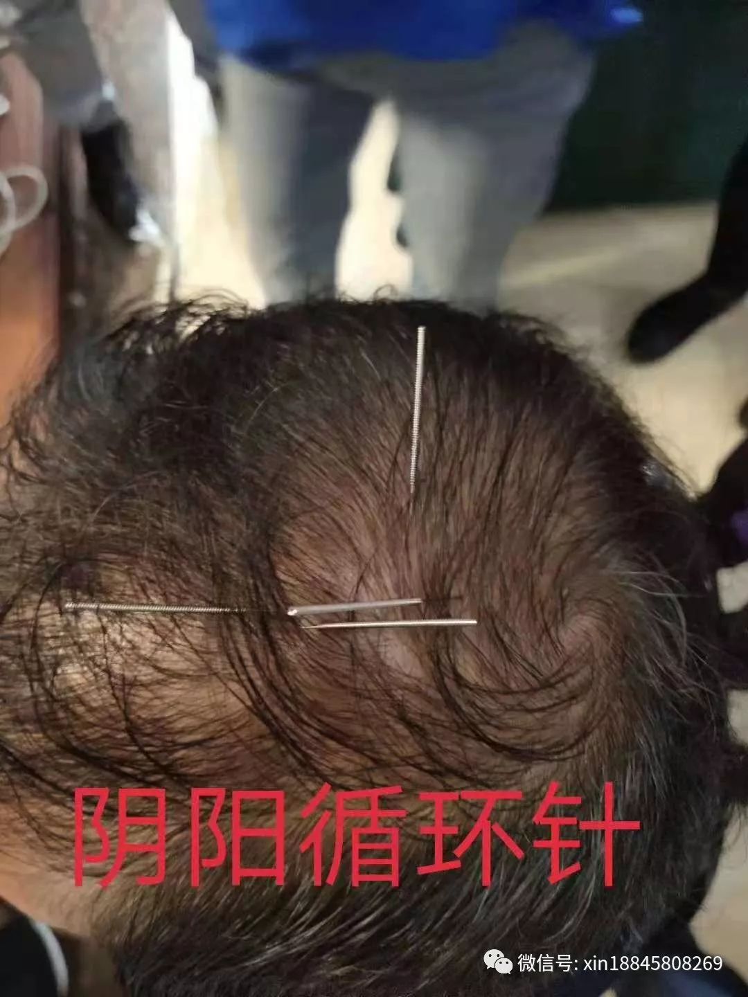 糖尿病怪三针  21   .