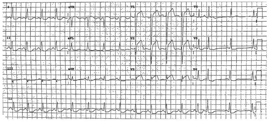 stemi→急性左心衰→心源性休克→心跳骤停 入院后予吸氧,心电监护