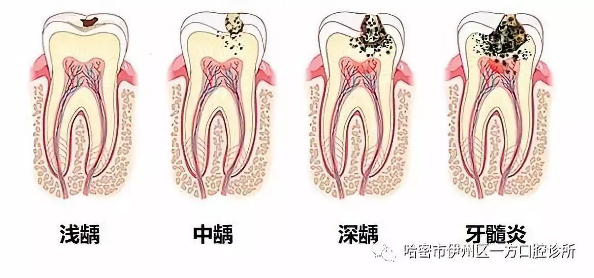 拔牙和种牙多少钱一颗