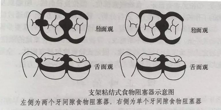 67>78>56②重建食物棑溢沟. ③恢复牙尖生理外形. ④扩大外展隙. 2.