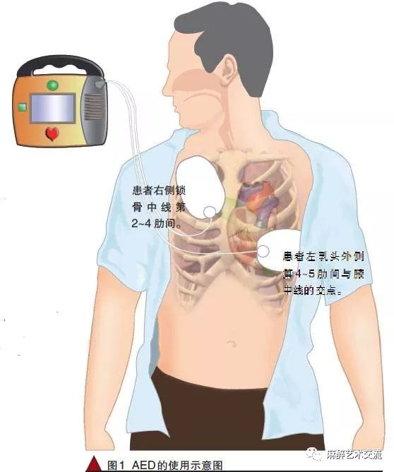 【急救必备】除颤仪的使用方法和流程