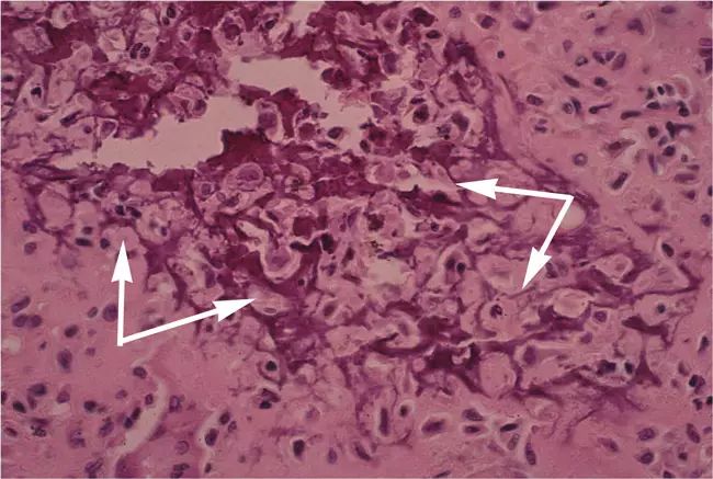 【科普教育】骨肿瘤,(三)成软骨细胞瘤chondroblastoma