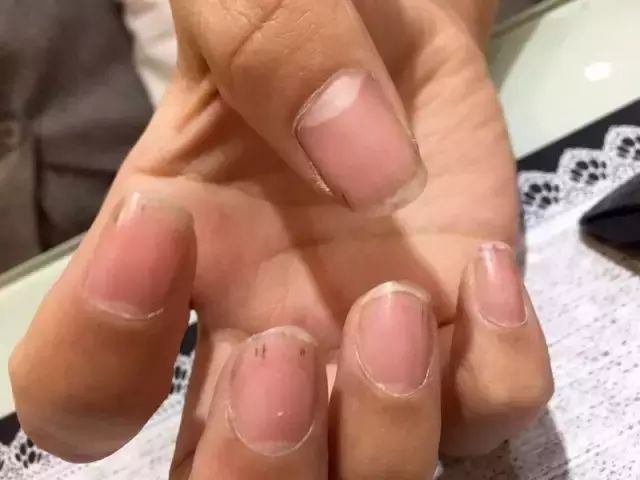 频繁美甲后,美甲师的指甲变得很薄,质量很差,都能看得出血丝,一碰就痛